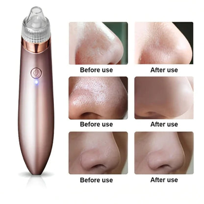 Electric Blackhead Acne Oil Remover & Vacuum Suction Face Pore Cleaner